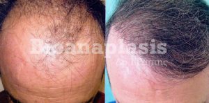 Μεταμόσχευση μαλλιών αποτελέσματα Bioanaplasis